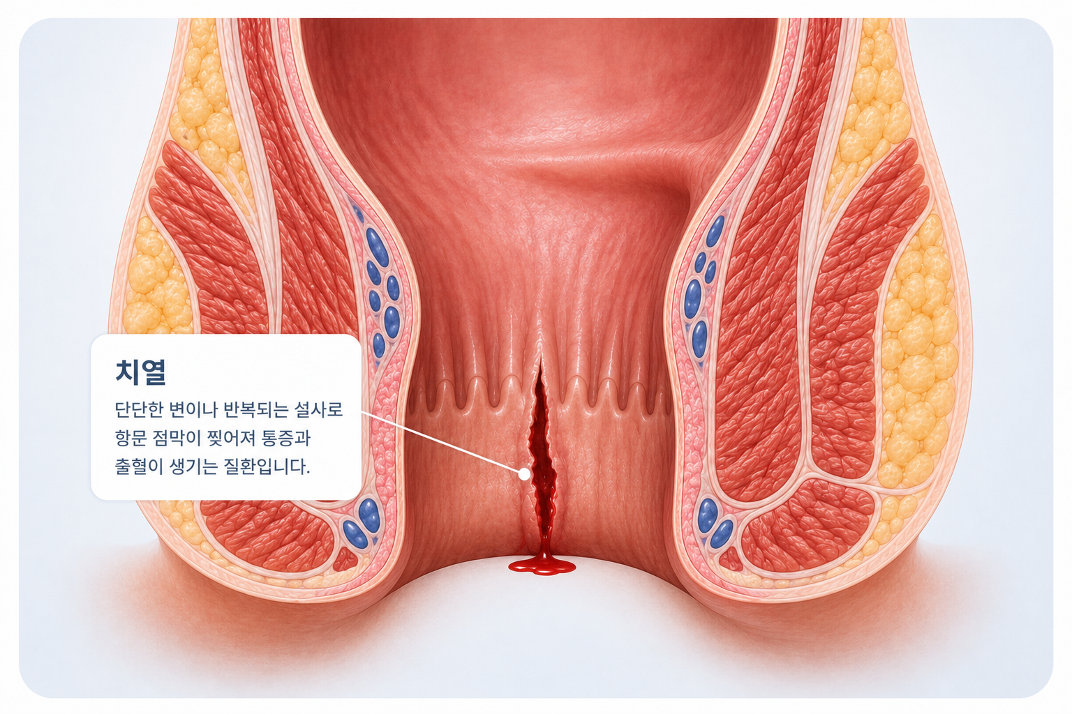 치열