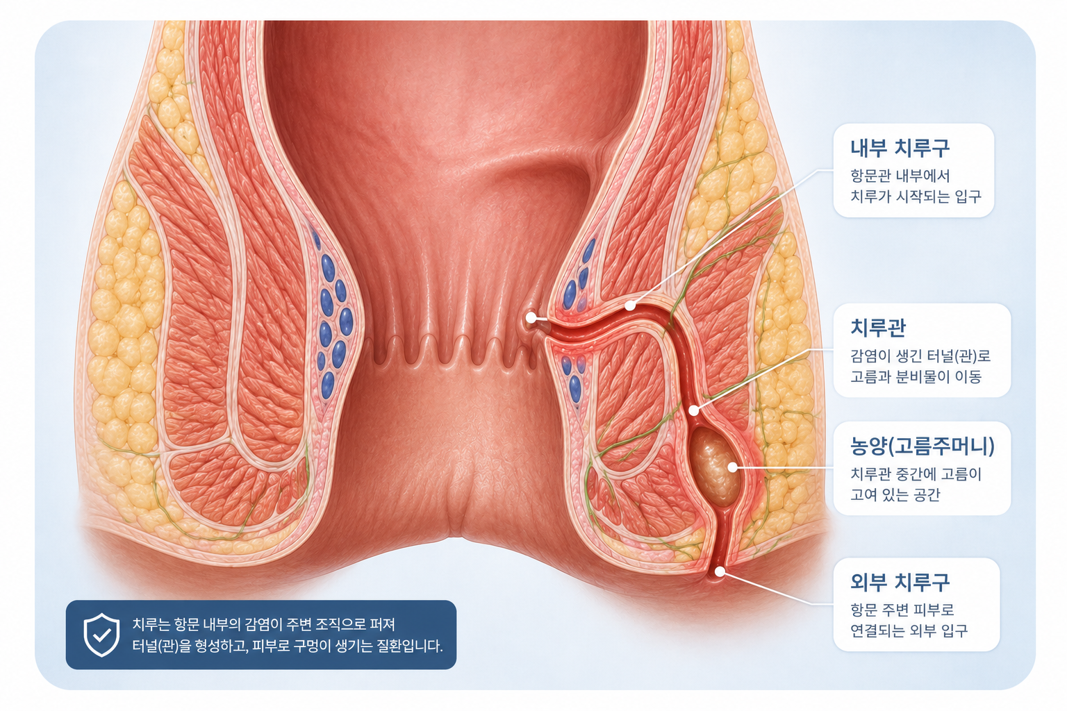 치루