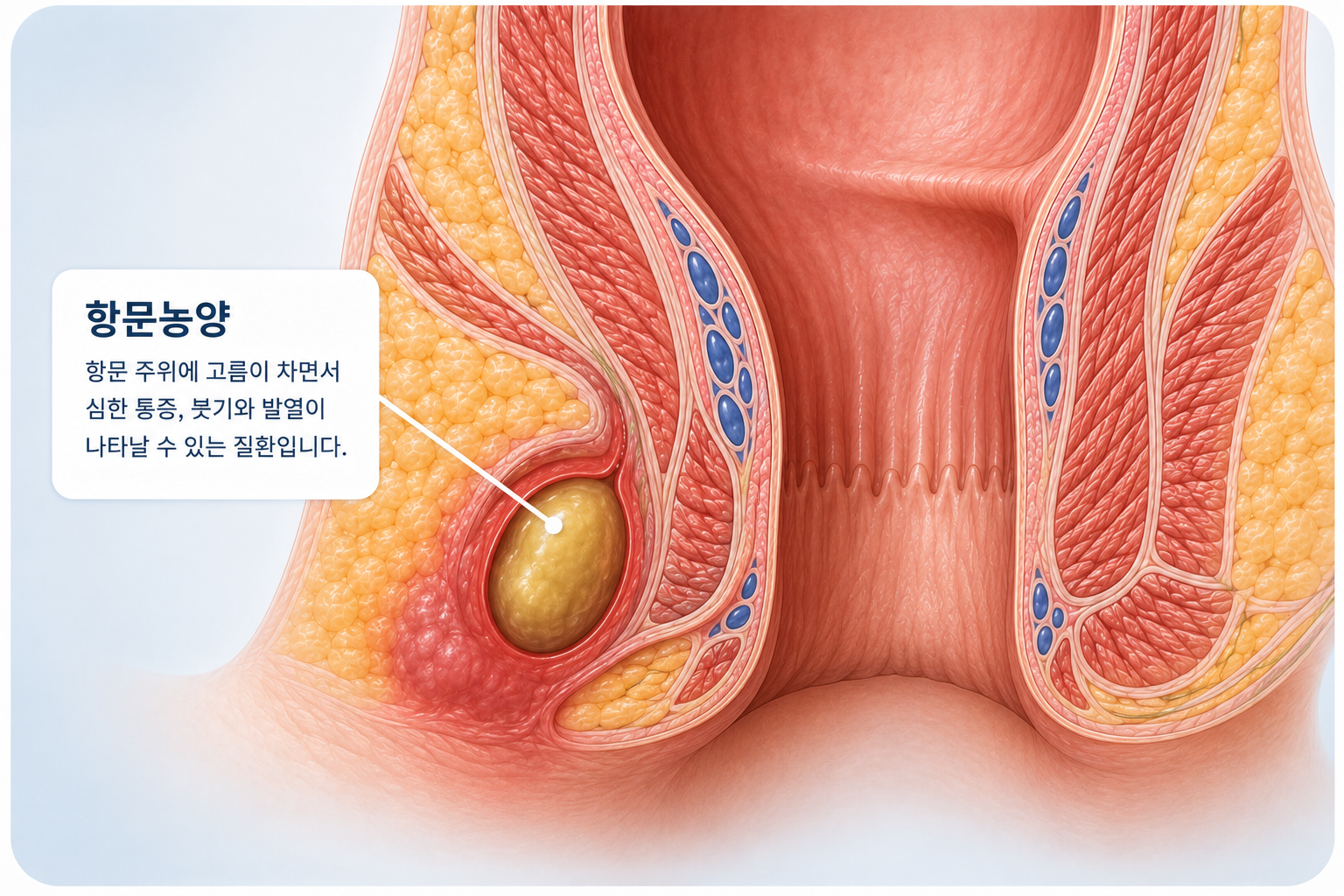 항문농양